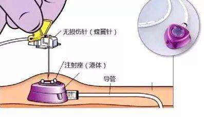 我院成功開展輸液港維護技術(shù)，填補我院靜脈治療領(lǐng)域又一空白
